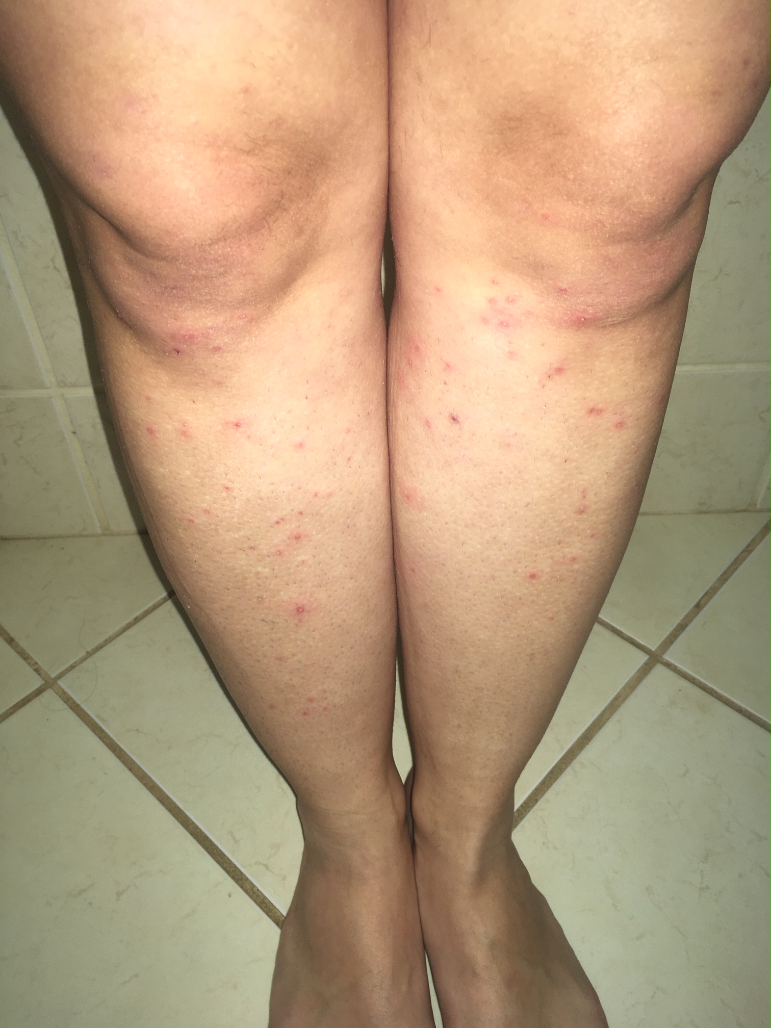 Foliculite na perna antes do tratamento com Tend Skin — pelos encravados inflamados